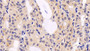 DAB staining on IHC-P; Sample: Human Thyroid cancer Tissue; Primary Ab: 20μg/ml Mouse Anti-Human ERK2 Antibody Second Ab: 2µg/mL HRP-Linked Caprine Anti-Mouse IgG Polyclonal Antibody