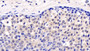 DAB staining on IHC-P; Sample: Human Breast cancer Tissue; Primary Ab: 20μg/ml Mouse Anti-Human ERK2 Antibody Second Ab: 2µg/mL HRP-Linked Caprine Anti-Mouse IgG Polyclonal Antibody