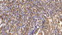 DAB staining on IHC-P; Sample: Human Stomach cancer Tissue; Primary Ab: 10ug/ml Rabbit Anti-Human IL4R Antibody Second Ab: 2µg/mL HRP-Linked Caprine Anti-Rabbit IgG Polyclonal Antibody