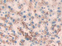 DAB staining on IHC-P; Samples: Human Liver cancer Tissue; Primary Ab: 40µg/ml Mouse Anti-Multi-species Ang1-7 Antibody Second Ab: 2µg/mL HRP-Linked Caprine Anti-Mouse IgG Polyclonal Antibody