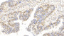 DAB staining on IHC-P; Samples: Human Colorectal cancer Tissue; Primary Ab: 10µg/ml Mouse Anti-Human FOXP3 Antibody Second Ab: 2µg/mL HRP-Linked Caprine Anti-Mouse IgG Polyclonal Antibody DAB staining on IHC-P; Samples: Human Colorectal cancer Tissue; Primary Ab: 10µg/ml Mouse Anti-Human FOXP3 Antibody Second Ab: 2µg/mL HRP-Linked Caprine Anti-Mouse IgG Polyclonal Antibody