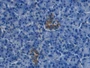 DAB staining on IHC-P; Samples: Human Pancreatic cancer Tissue; Primary Ab: 20µg/ml Mouse Anti-Human EDN1 Antibody Second Ab: 2µg/mL HRP-Linked Caprine Anti-Mouse IgG Polyclonal Antibody