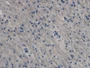 DAB staining on IHC-P; Samples: Human Glioma Tissue; Primary Ab: 20µg/ml Mouse Anti-Human EDN1 Antibody Second Ab: 2µg/mL HRP-Linked Caprine Anti-Mouse IgG Polyclonal Antibody