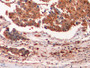 DAB staining on IHC-P; Samples: Human Liver cancer Tissue; Primary Ab: 10µg/ml Mouse Anti-Multi-species Ub Antibody Second Ab: 2µg/mL HRP-Linked Caprine Anti-Mouse IgG Polyclonal Antibody