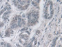 DAB staining on IHC-P; Samples: Human Liver cancer Tissue; Primary Ab: 10µg/ml Rabbit Anti-Human Ub Antibody Second Ab: 2µg/mL HRP-Linked Caprine Anti-Rabbit IgG Polyclonal Antibody