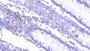 DAB staining on IHC-P; Samples: Human Colon Tissue; Primary Ab: 20μg/ml Rabbit Anti-Human S100A8 Antibody Second Ab: 2µg/mL HRP-Linked Caprine Anti-Rabbit IgG Polyclonal Antibody