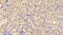 DAB staining on IHC-P; Samples: Human Ovarian cancer Tissue;  Primary Ab: 20μg/ml Rabbit Anti-Human WNT7B Antibody Second Ab: 2µg/mL HRP-Linked Caprine Anti-Rabbit IgG Polyclonal Antibody 