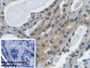 DAB staining on IHC-P; Sample: Human Thyroid cancer Tissue; Primary Ab: 30ug/ml Mouse Anti-Human GAPDH Antibody; Control: Used PBS instead of primary antibody; Second Ab: 2ug/ml HRP-Linked Caprine Anti-Mouse IgG Polyclonal Antibody