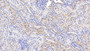 DAB staining on IHC-P; Samples: Human Kidney Tissue; Primary Ab: 20ug/ml Rabbit Anti-Human HbA1C Antibody; Second Ab: 2ug/mL HRP-Linked Caprine Anti-Rabbit IgG Polyclonal Antibody