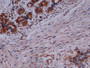 DAB staining on IHC-P; Sample: Human Breast cancer Tissue; Primary Ab: 10ug/ml Rabbit Anti-Multi-species SYP Antibody; Second Ab: 2ug/mL HRP-Linked Caprine Anti-Rabbit IgG Polyclonal Antibody