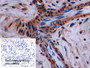 DAB staining on IHC-P; Sample: Human Breast cancer Tissue; Primary Ab: 10ug/ml Rabbit Anti-Multi-species SYP Antibody; Control: Used PBS instead of primary antibody; Second Ab: 2ug/ml HRP-Linked Caprine Anti-Rabbit IgG Polyclonal Antibody