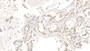 DAB staining on IHC-P; Sample: Human Lung cancer Tissue; Primary Ab: 10ug/ml Mouse Anti-Human KRT18 Antibody; Second Ab: 2ug/mL HRP-Linked Caprine Anti-Mouse IgG Polyclonal Antibody