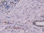 DAB staining on IHC-P; Sample: Human Breast cancer Tissue; Primary Ab: 10ug/ml Mouse Anti-Human VIM Antibody Second Ab: 2ug/mL HRP-Linked Caprine Anti-Mouse IgG Polyclonal Antibody