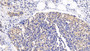 DAB staining on IHC-P; Sample: Human Breast cancer Tissue; Primary Ab: 20ug/ml Rabbit Anti-Human TSC1 Antibody; Second Ab: 2ug/mL HRP-Linked Caprine Anti-Rabbit IgG Polyclonal Antibody