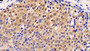 DAB staining on IHC-P; Sample: Human Breast cancer Tissue; Primary Ab: 20ug/ml Mouse Anti-Human ERK1 Antibody Second Ab: 2ug/mL HRP-Linked Caprine Anti-Mouse IgG Polyclonal Antibody
