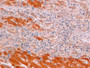 DAB staining on IHC-P; Sample: Human Liver cancer Tissue; Primary Ab: 10ug/ml Mouse Anti-Human β-catenin Antibody Second Ab: 2ug/mL HRP-Linked Caprine Anti-Mouse IgG Polyclonal Antibody