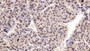 DAB staining on IHC-P; Sample: Human Liver cancer Tissue; Primary Ab: 10ug/ml Mouse Anti-Human HDAC1 Antibody Second Ab: 2ug/mL HRP-Linked Caprine Anti-Mouse IgG Polyclonal Antibody