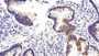 DAB staining on IHC-P; Sample: Human Colorectal cancer Tissue; Primary Ab: 20ug/ml Mouse Anti-Human VEGFC Antibody Second Ab: 2ug/mL HRP-Linked Caprine Anti-Mouse IgG Polyclonal Antibody