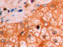 DAB staining on IHC-P; Sample: Human Liver Tissue; Primary Ab: 10ug/ml Mouse Anti-Human β-catenin Antibody; Second Ab: 2ug/mL HRP-Linked Caprine Anti-Mouse IgG Polyclonal Antibody