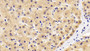 DAB staining on IHC-P; Samples: Human Liver Tissue; Primary Ab: 20ug/ml Mouse Anti-Human MMP13 Antibody; Second Ab: 2ug/mL HRP-Linked Caprine Anti-Mouse IgG Polyclonal Antibody