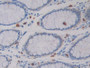 DAB staining on IHC-P; Sample: Human Colorectal cancer Tissue; Primary Ab: 30ug/ml Mouse Anti-Human IDH1 Antibody Second Ab: 2ug/mL HRP-Linked Caprine Anti-Mouse IgG Polyclonal Antibody