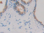 DAB staining on IHC-P; Sample: Human Prostate Tissue; Primary Ab: 30ug/ml Mouse Anti-Human IDH1 Antibody; Second Ab: 2ug/mL HRP-Linked Caprine Anti-Mouse IgG Polyclonal Antibody