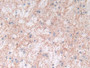 DAB staining on IHC-P; Sample: Human Glioma Tissue; Primary Ab: 30ug/ml Mouse Anti-Human BNP Antibody Second Ab: 2ug/mL HRP-Linked Caprine Anti-Mouse IgG Polyclonal Antibody