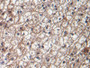 DAB staining on IHC-P; Samples: Human Liver Tissue; Primary Ab: 20ug/ml Mouse Anti-Human TGFb1 Antibody Second Ab: 2ug/mL HRP-Linked Caprine Anti-Mouse IgG Polyclonal Antibody