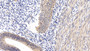 DAB staining on IHC-P; Sample: Human Endometrial cancer Tissue; Primary Ab: 20ug/ml Rabbit Anti-Human IRS1 Antibody; Second Ab: 2ug/mL HRP-Linked Caprine Anti-Rabbit IgG Polyclonal Antibody