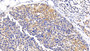 DAB staining on IHC-P; Sample: Human Breast cancer Tissue; Primary Ab: 20ug/ml Rabbit Anti-Human IRS1 Antibody; Second Ab: 2ug/mL HRP-Linked Caprine Anti-Rabbit IgG Polyclonal Antibody