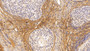 DAB staining on IHC-P; Sample: Human Ovary Tissue; Primary Ab: 20ug/ml Mouse Anti-Human PIIINP Antibody; Second Ab: 2ug/mL HRP-Linked Caprine Anti-Mouse IgG Polyclonal Antibody