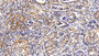 DAB staining on IHC-P; Sample: Human Stomach cancer Tissue; Primary Ab: 20ug/ml Rabbit Anti-Human GCSFR Antibody; Second Ab: 2ug/mL HRP-Linked Caprine Anti-Rabbit IgG Polyclonal Antibody