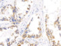DAB staining on IHC-P; Sample: Human Lung cancer Tissue; Primary Ab: 10ug/ml Mouse Anti-Human KRT17 Antibody; Second Ab: 2ug/mL HRP-Linked Caprine Anti-Mouse IgG Polyclonal Antibody