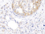 DAB staining on IHC-P; Sample: Human Breast cancer Tissue; Primary Ab: 10ug/ml Mouse Anti-Human KRT17 Antibody; Second Ab: 2ug/mL HRP-Linked Caprine Anti-Mouse IgG Polyclonal Antibody