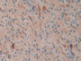 DAB staining on IHC-P; Sample: Human Glioma Tissue; Primary Ab: 30ug/ml Mouse Anti-Human Hsp27 Antibody Second Ab: 2ug/mL HRP-Linked Caprine Anti-Mouse IgG Polyclonal Antibody