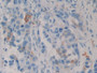 DAB staining on IHC-P; Sample: Human Breast cancer Tissue; Primary Ab: 30ug/ml Mouse Anti-Human HSPB1 Antibody Second Ab: 2ug/mL HRP-Linked Caprine Anti-Mouse IgG Polyclonal Antibody