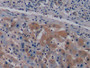 DAB staining on IHC-P; Sample: Human Liver cancer Tissue; Primary Ab: 10ug/ml Mouse Anti-Human VEGF165 Antibody; Second Ab: 2ug/mL HRP-Linked Caprine Anti-Mouse IgG Polyclonal Antibody
