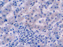 DAB staining on IHC-P; Sample: Human Liver cancer Tissue; Primary Ab: 10ug/ml Mouse Anti-Human Arg Antibody Second Ab: 2ug/mL HRP-Linked Caprine Anti-Mouse IgG Polyclonal Antibody