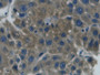 DAB staining on IHC-P; Sample: Human Liver cancer Tissue; Primary Ab: 30ug/ml Mouse Anti-Human Hpt Antibody; Second Ab: 2ug/mL HRP-Linked Caprine Anti-Mouse IgG Polyclonal Antibody
