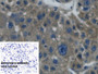 DAB staining on IHC-P; Sample: Human Liver cancer Tissue; Primary Ab: 30ug/ml Mouse Anti-Human Hpt Antibody; Control: Used PBS instead of primary antibody; Second Ab: 2ug/ml HRP-Linked Caprine Anti-Mouse IgG Polyclonal Antibody