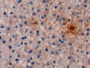 DAB staining on IHC-P; Sample: Human Liver Tissue; Primary Ab: 10ug/ml Mouse Anti-Human aFP Antibody; Second Ab: 2ug/mL HRP-Linked Caprine Anti-Mouse IgG Polyclonal Antibody