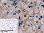 DAB staining on IHC-P; Sample: Human Liver Tissue; Primary Ab: 10ug/ml Mouse Anti-Human aFP Antibody; Control: Used PBS instead of primary antibody; Second Ab: 2ug/ml HRP-Linked Caprine Anti-Mouse IgG Polyclonal Antibody