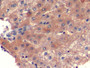 DAB staining on IHC-P; Sample: Human Liver Tissue; Primary Ab: 10ug/ml Mouse Anti-Human aFP Antibody Second Ab: 2ug/mL HRP-Linked Caprine Anti-Mouse IgG Polyclonal Antibody
