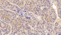 DAB staining on IHC-P; Sample: Human Liver cancer Tissue; Primary Ab: 10ug/ml Mouse Anti-Human IFNa/bR1 Antibody; Second Ab: 2ug/mL HRP-Linked Caprine Anti-Mouse IgG Polyclonal Antibody