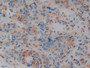 DAB staining on IHC-P; Sample: Human Prostate cancer Tissue; Primary Ab: 20ug/ml Mouse Anti-Human AREG Antibody; Second Ab: 2ug/mL HRP-Linked Caprine Anti-Mouse IgG Polyclonal Antibody