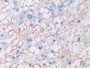 DAB staining on IHC-P; Sample: Human Glioma Tissue; Primary Ab: 30ug/ml Mouse Anti-Human AREG Antibody; Second Ab: 2ug/mL HRP-Linked Caprine Anti-Mouse IgG Polyclonal Antibody