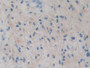 DAB staining on IHC-P; Sample: Human Glioma Tissue; Primary Ab: 30ug/ml Mouse Anti-Human IDH1 Antibody; Second Ab: 2ug/mL HRP-Linked Caprine Anti-Mouse IgG Polyclonal Antibody