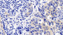 DAB staining on IHC-P; Sample: Human Lymphoma Tissue; Primary Ab: 20ug/ml Mouse Anti-Human CASP9 Antibody Second Ab: 2ug/mL HRP-Linked Caprine Anti-Mouse IgG Polyclonal Antibody