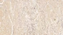 DAB staining on IHC-P; Sample: Human Prostate Tissue; Primary Ab: 10ug/ml Mouse Anti-Human SDC1 Antibody; Second Ab: 2ug/mL HRP-Linked Caprine Anti-Mouse IgG Polyclonal Antibody