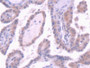 DAB staining on IHC-P; Sample: Human Thyroid cancer Tissue; Primary Ab: 30ug/ml Mouse Anti-Human EPO Antibody Second Ab: 2ug/mL HRP-Linked Caprine Anti-Mouse IgG Polyclonal Antibody